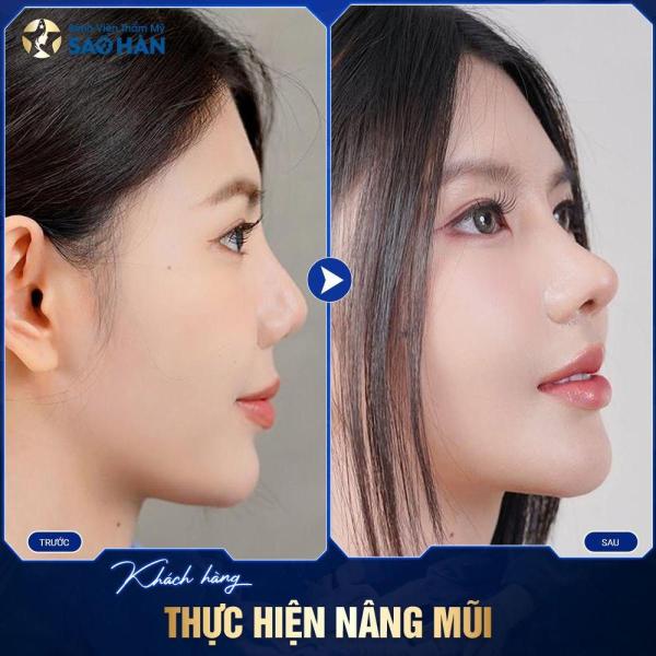 Nâng Mũi Cấu Trúc S-Line Megaderm