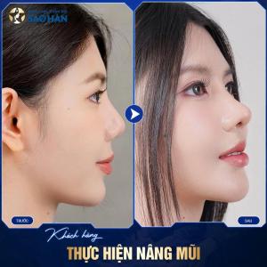 Nâng Mũi Cấu Trúc S-Line Megaderm