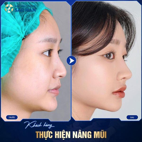 Nâng Mũi Cấu Trúc Kết Hợp Chỉnh Gồ
