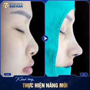 Nâng Mũi S-Line + Chỉnh Vẹo