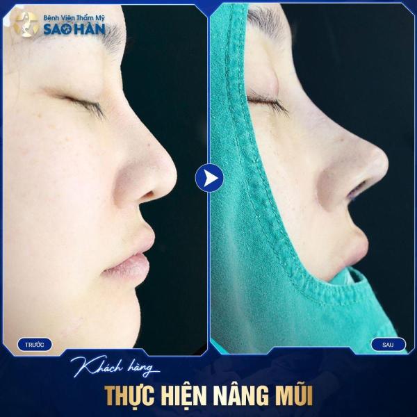 Nâng Mũi Cấu Trúc S-Line Sụn Tai