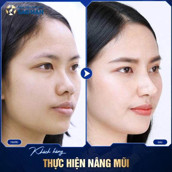 Nâng Mũi Bọc Sụn Megaderm