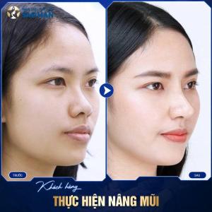 Nâng Mũi Bọc Sụn Megaderm