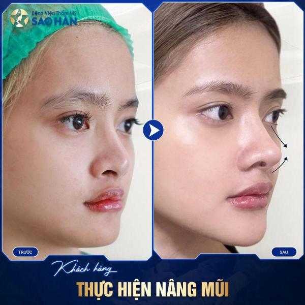 Nâng Mũi Bán Cấu Trúc Sụn Tai