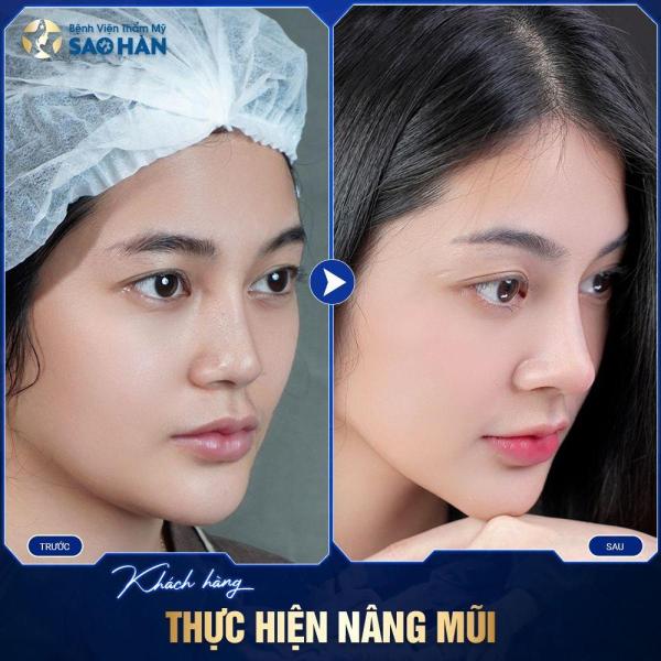 Thu hẹp xương mũi ko đặt sóng
