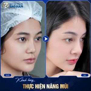 Thu hẹp xương mũi ko đặt sóng