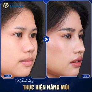 Phẫu Thuật Mũi Gồ Không Đặt Sóng