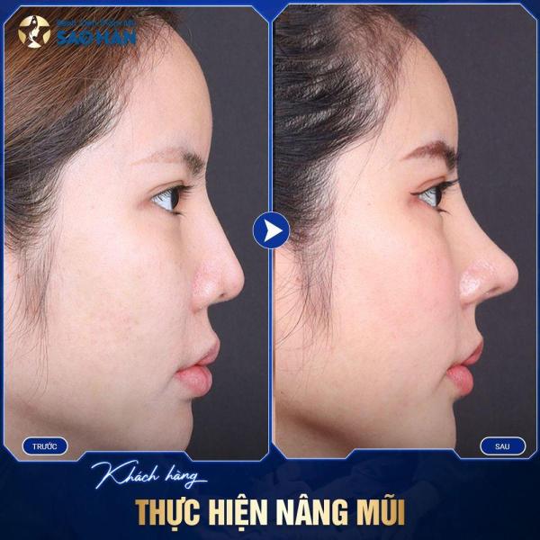 Nâng Mũi Sụn Mềm Hàn Quốc