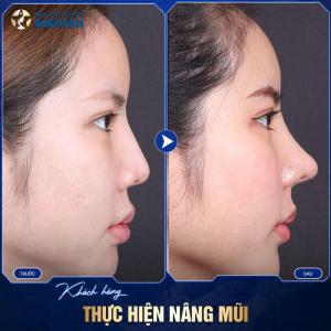 Nâng Mũi Sụn Mềm Hàn Quốc