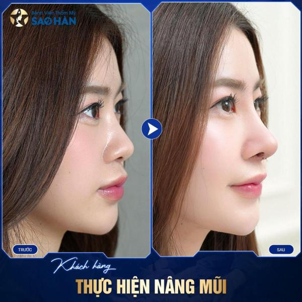 Cắt cánh mũi