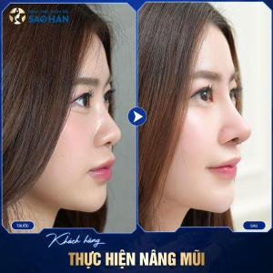 Cắt cánh mũi